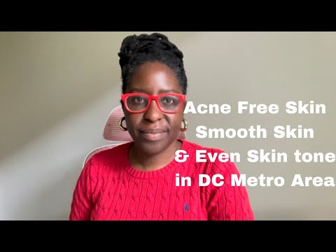 How to get acne free skin in the Northern Virginia and DC Metro Area