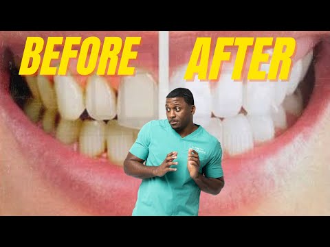 Four EASY Steps To Removing Yellow Tartar ASAP!